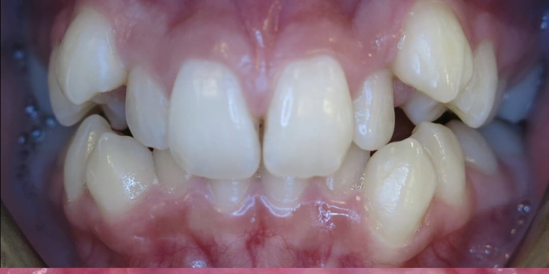 Before: InSmile Smile Transformation